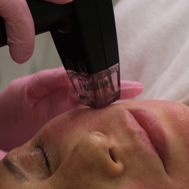 Микроигольчатый RF-лифтинг