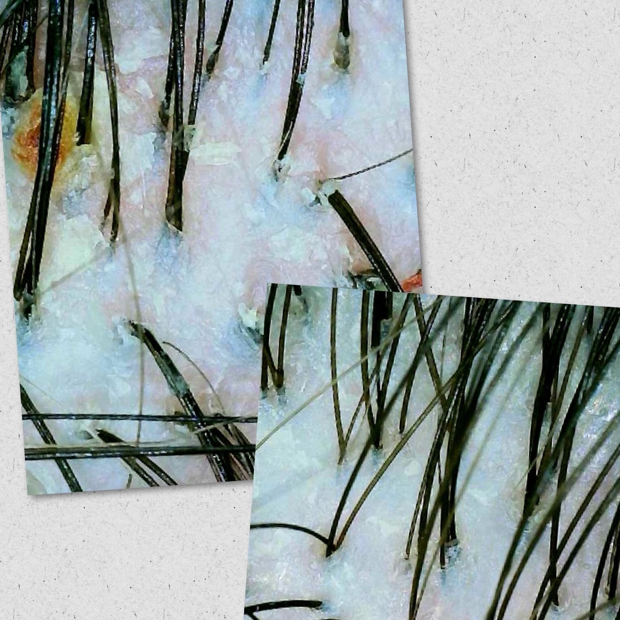 Пилинг кожи головы (дополнение к уходу)