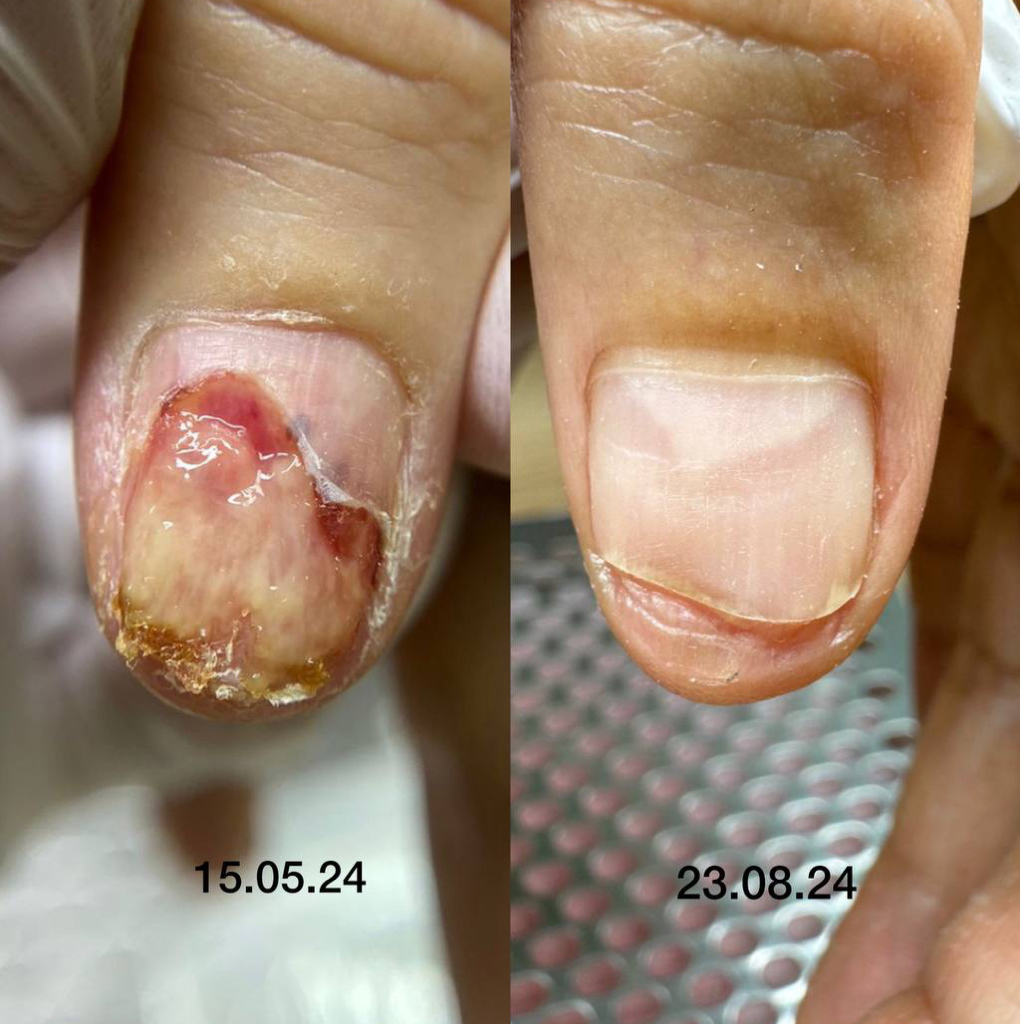 Обработка травмы, ожога, (онихолизиса) + санация ногтевого ложа