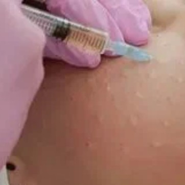 Мезотерапия