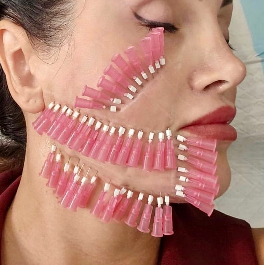 Мезонити полимолочные 60 нитей