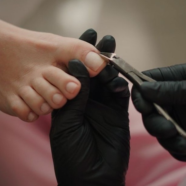 6. КОРРЕКЦИЯ ВРОСШЕГО НОГТЯ 2 СТЕПЕНИ