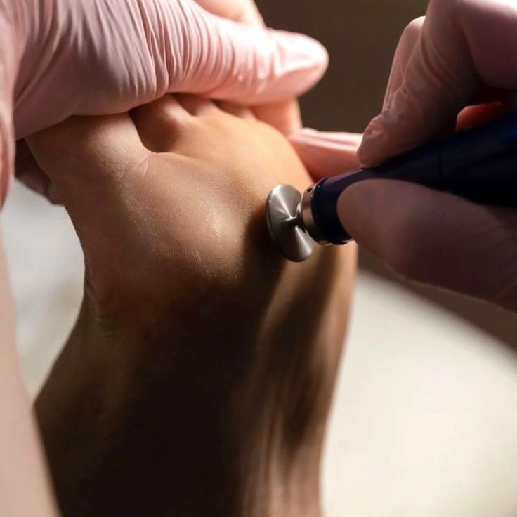 Подологическая обработка стоп 2 степени