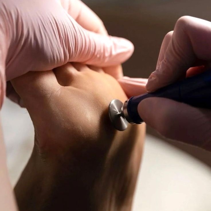 Подологическая обработка стоп 1 степени