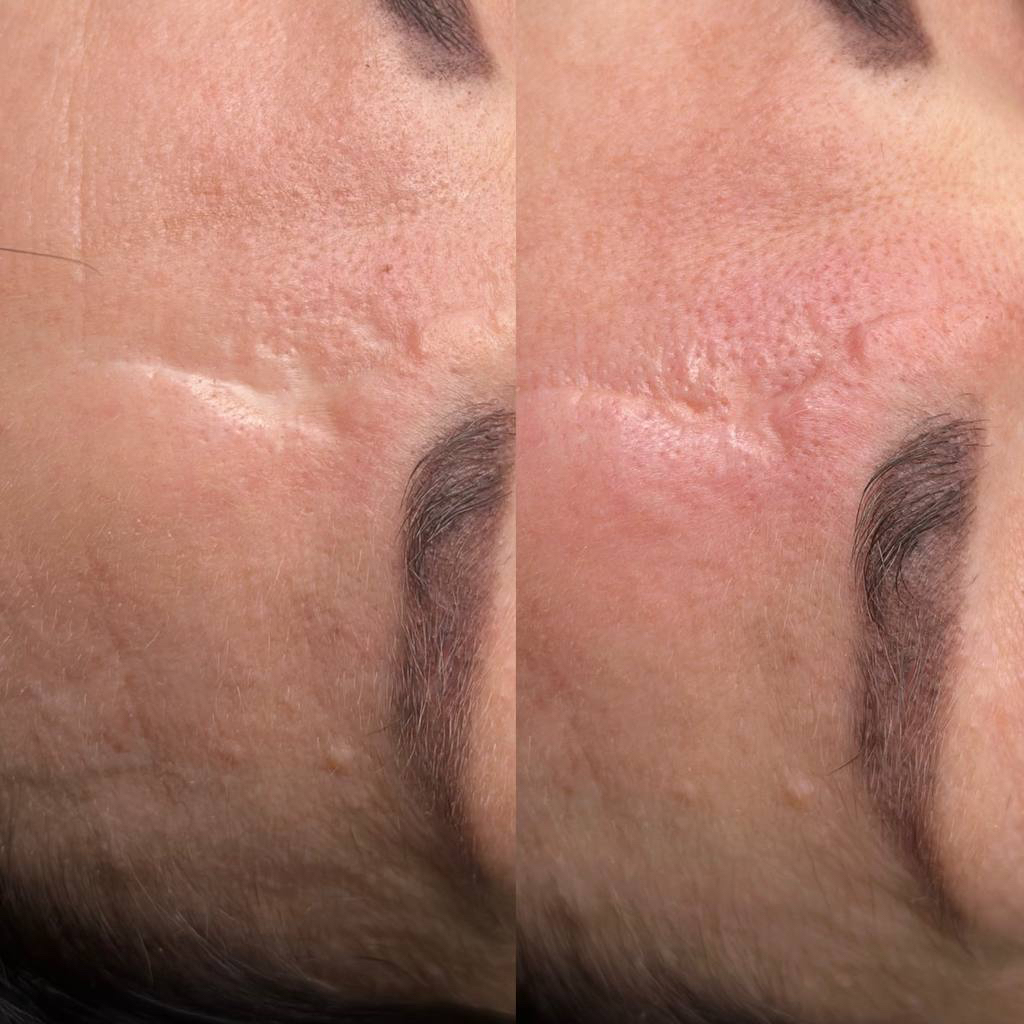 Камуфляж шрамов