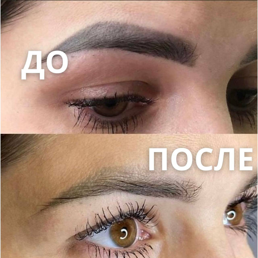 Удаление тату и перманента лазером