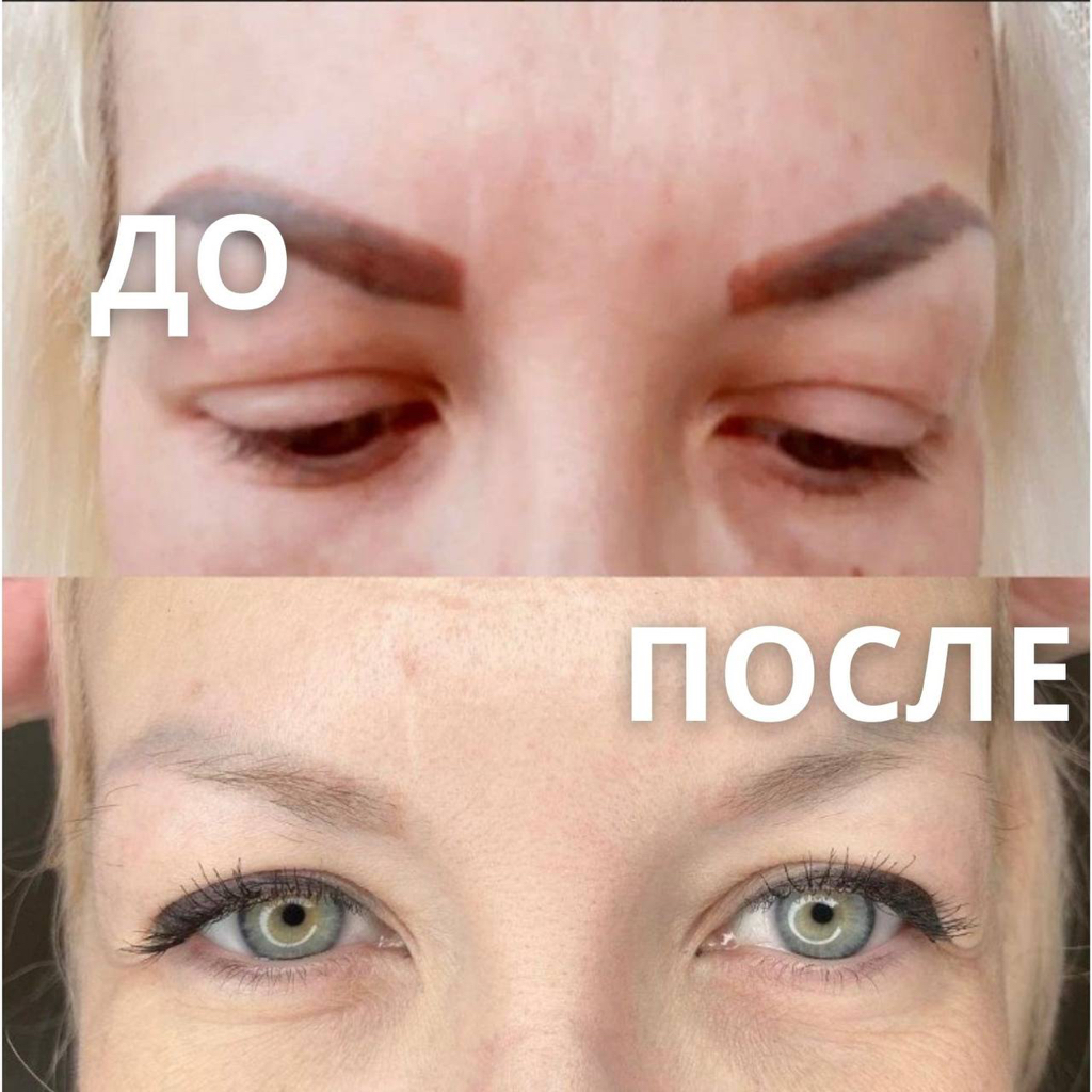 Удаление тату и перманента ремувером