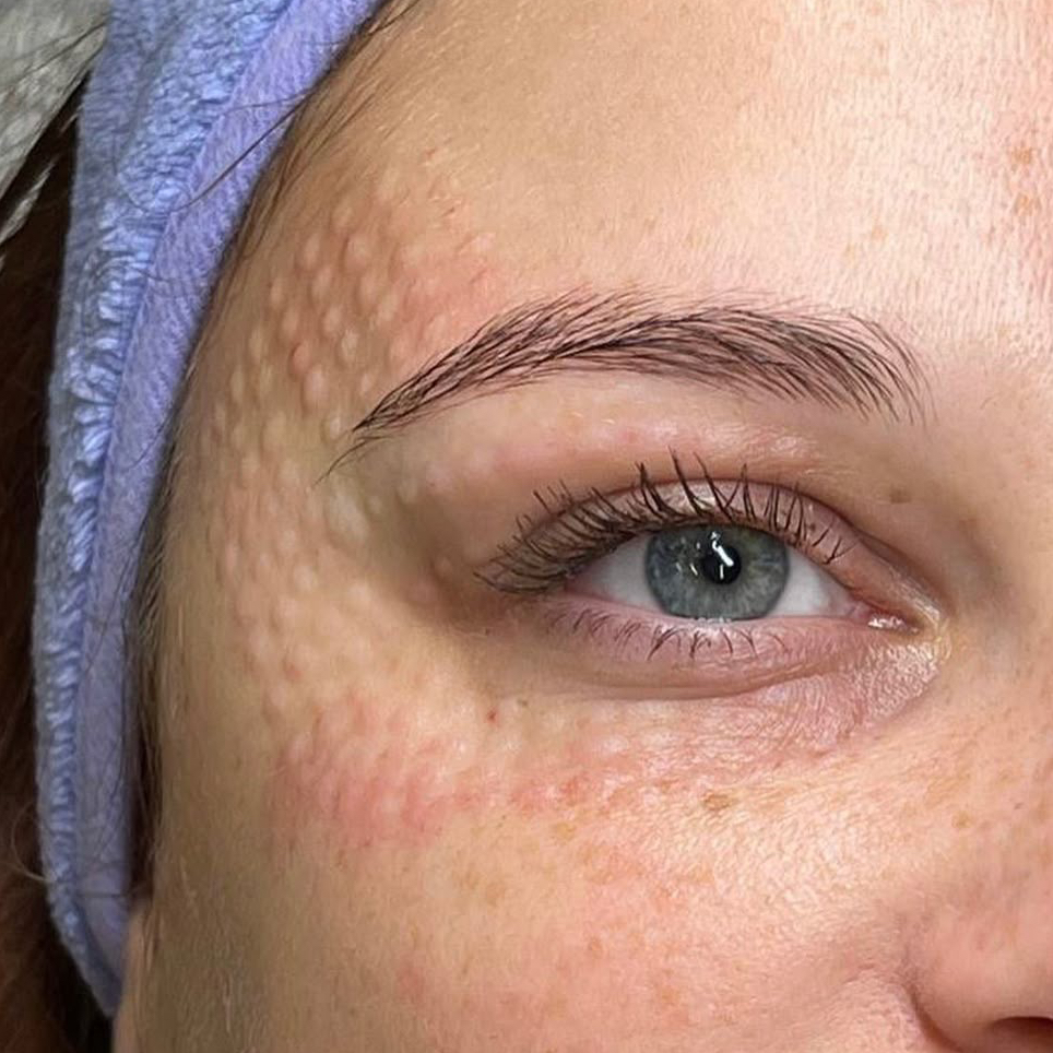 Мезотерапия периорбитальной зоны