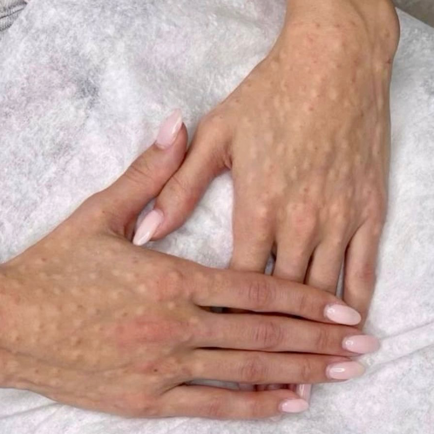 Биоревитализация кистей рук