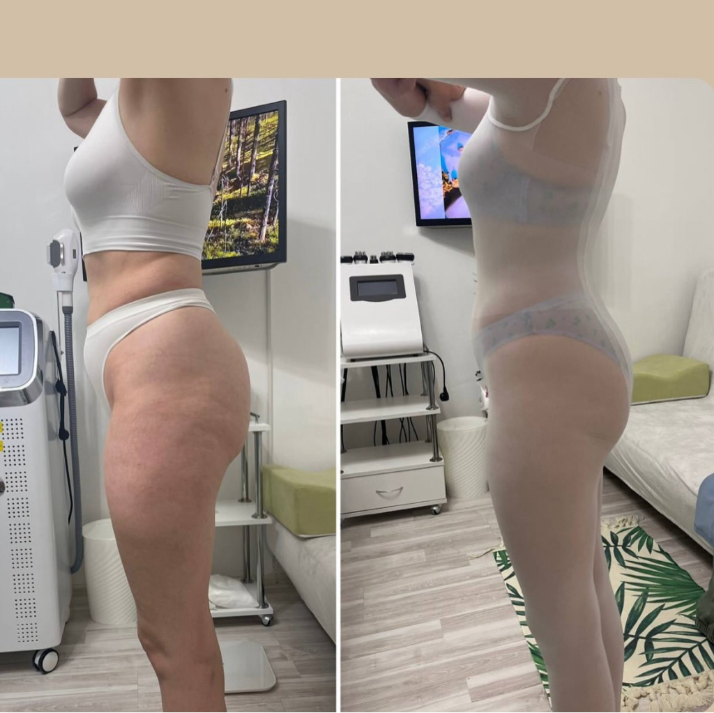 Lpg 30 мин+ вакуумный массаж 30 мин