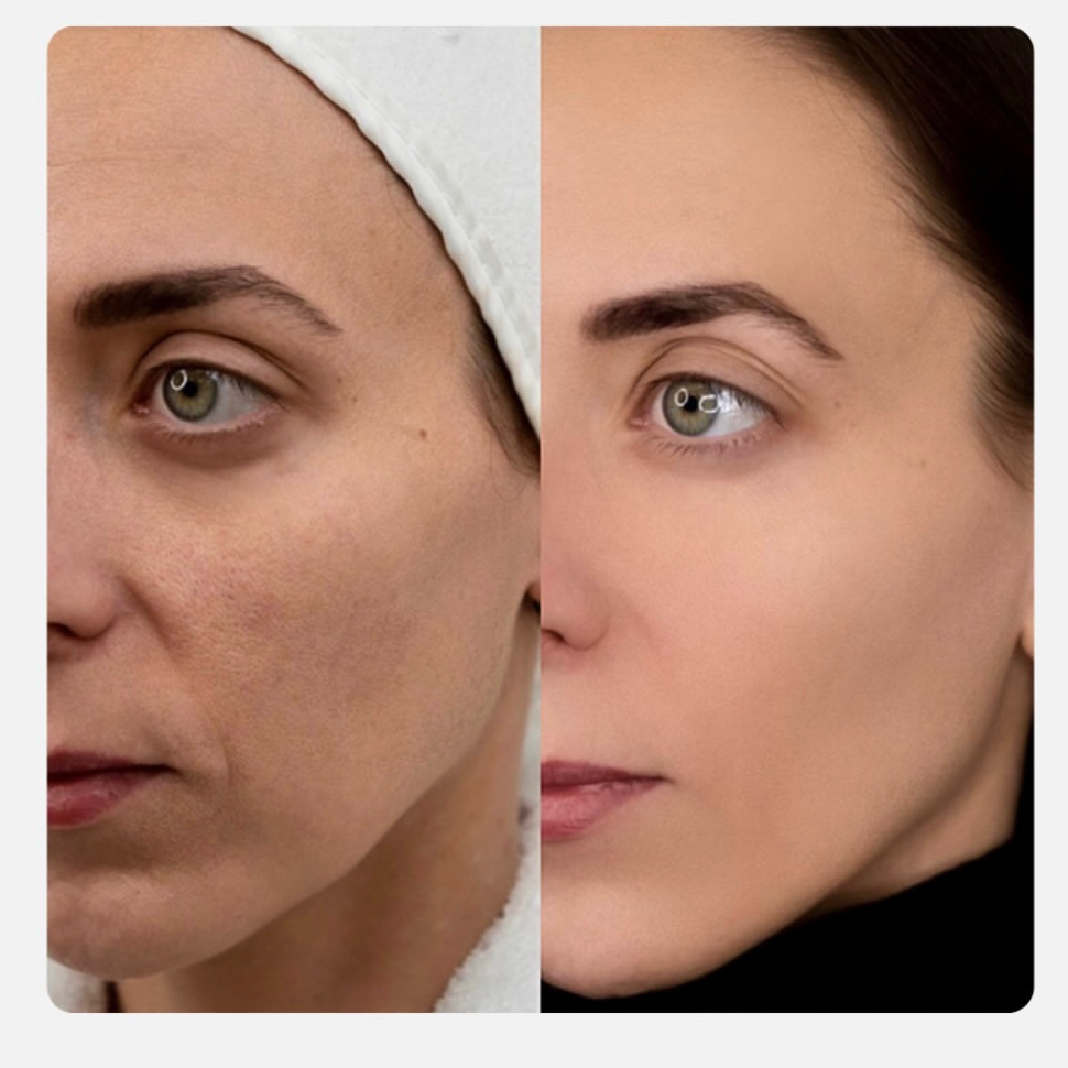 Элос пигментация 1 зона