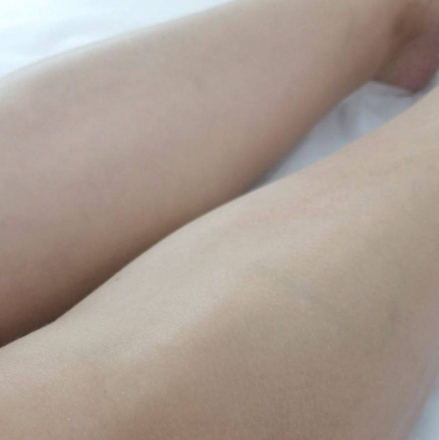 голени + подмышки александритовый лазер Candela