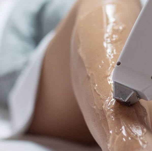 коррекция лазер Candela нескольких зон | одной зоны