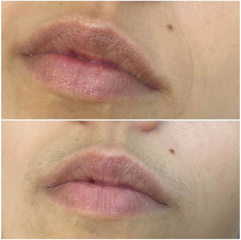 лицо полностью александритовый лазер CANDELA