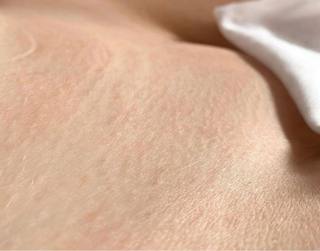 классическое бикини александритовый лазер Candela