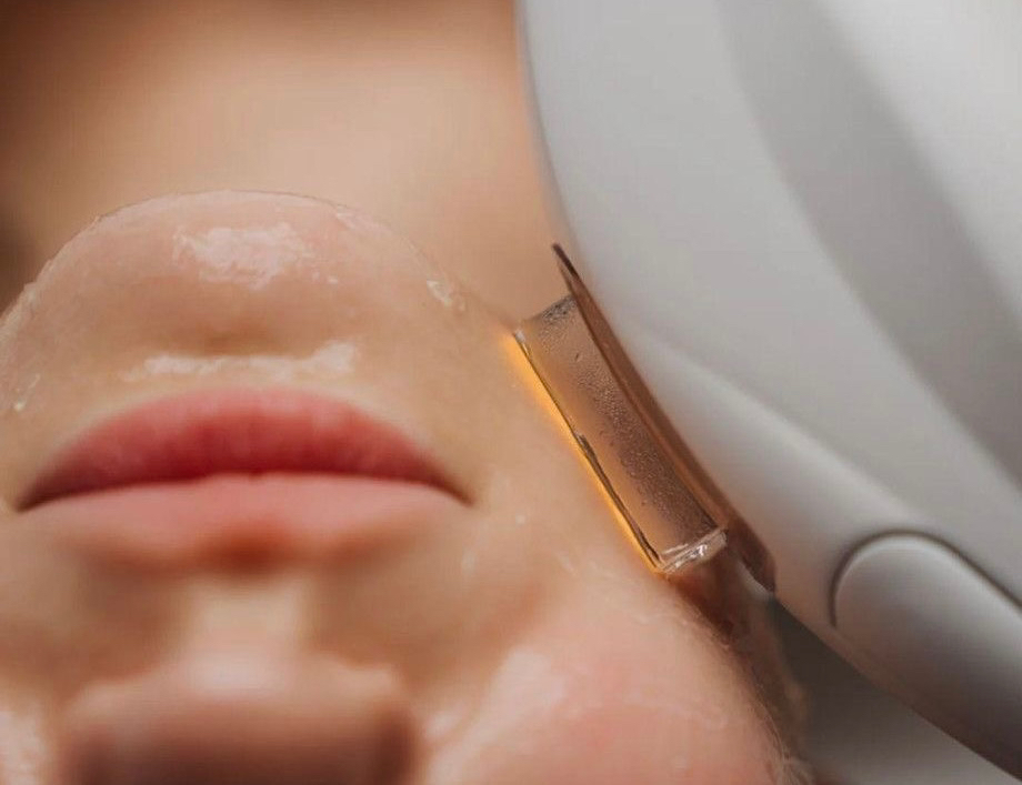 маленькие зоны на лице александритовый лазер Candela