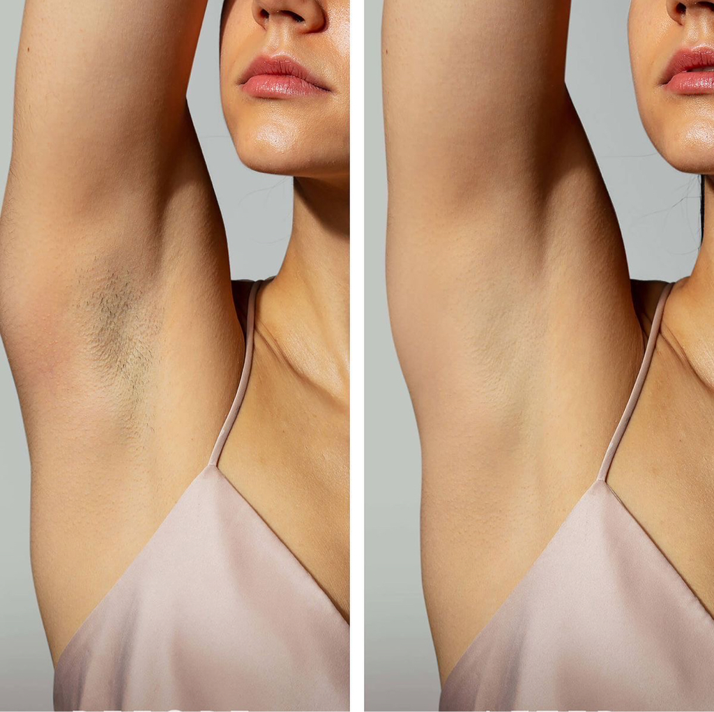 подмышки александритовый лазер Candela