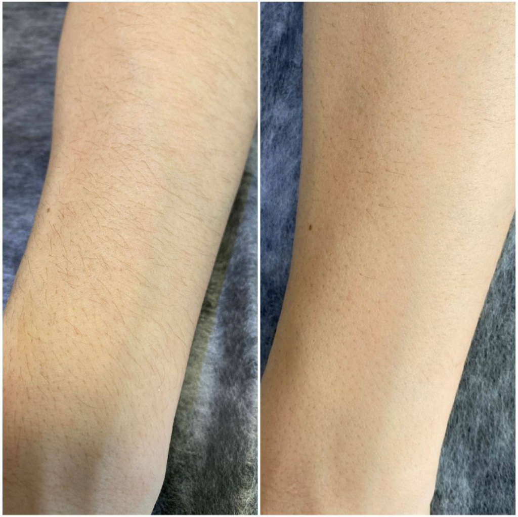 руки до локтя александритовый лазер Candela