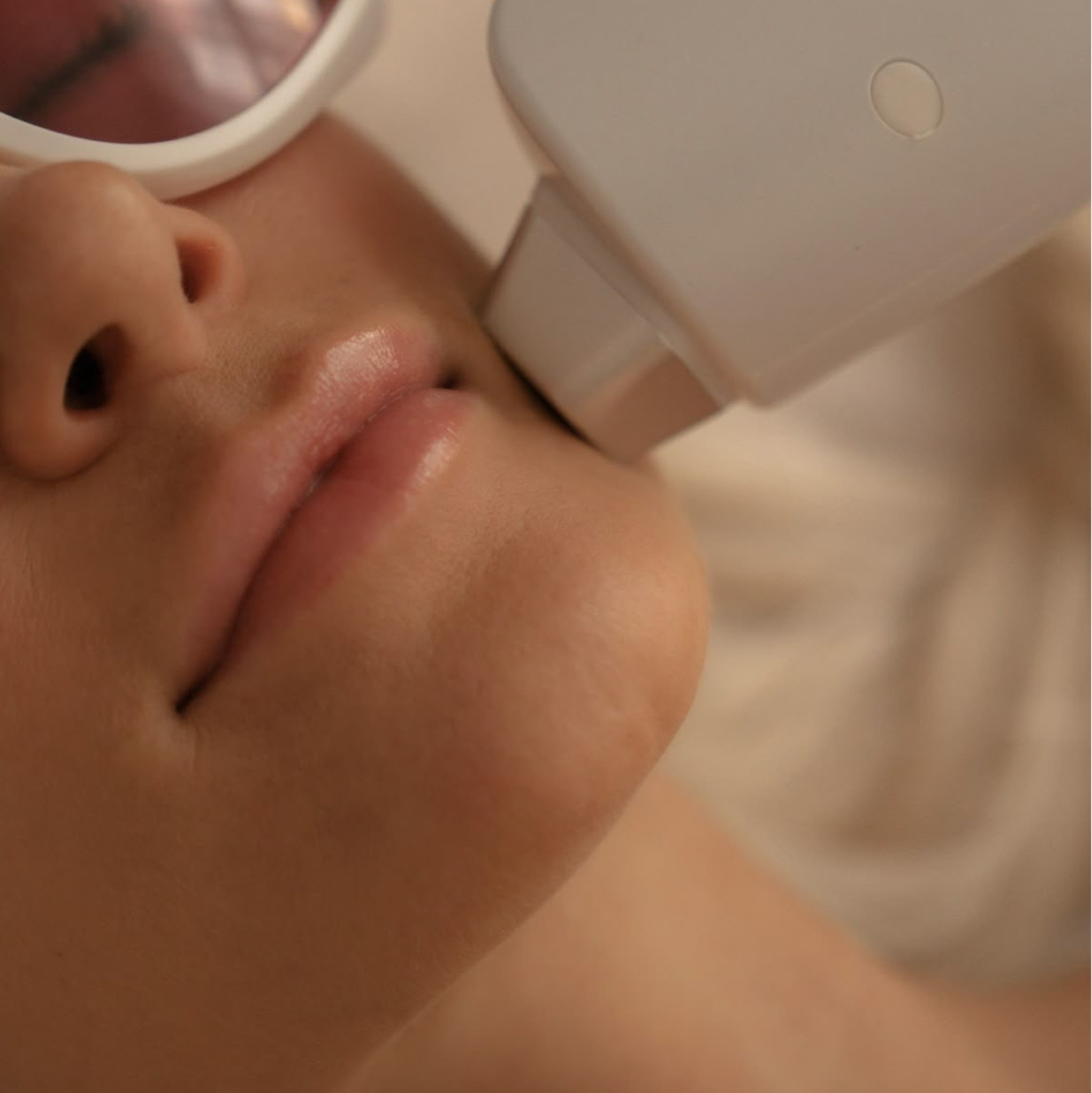 подбородок александритовый лазер CANDELA