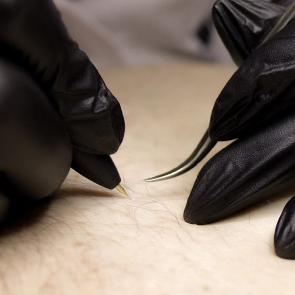 Электроэпиляция любой зоны