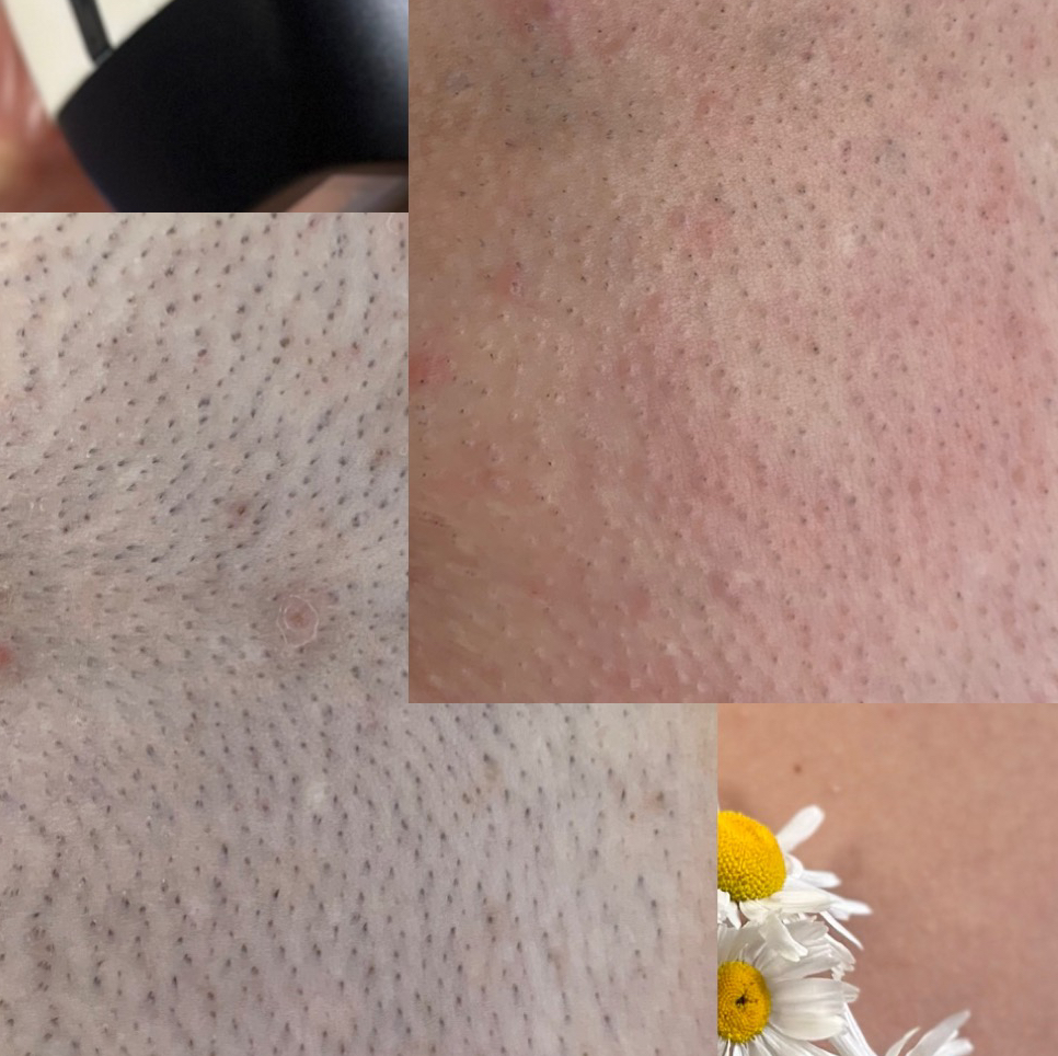 Эпиляция глубокого бикини