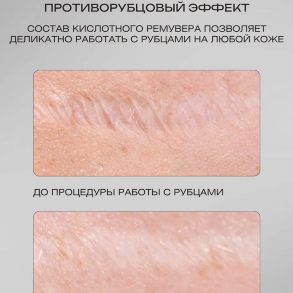 Консультация специалиста камуфляжа, рубцов, шрамов, растяжек, витилиго