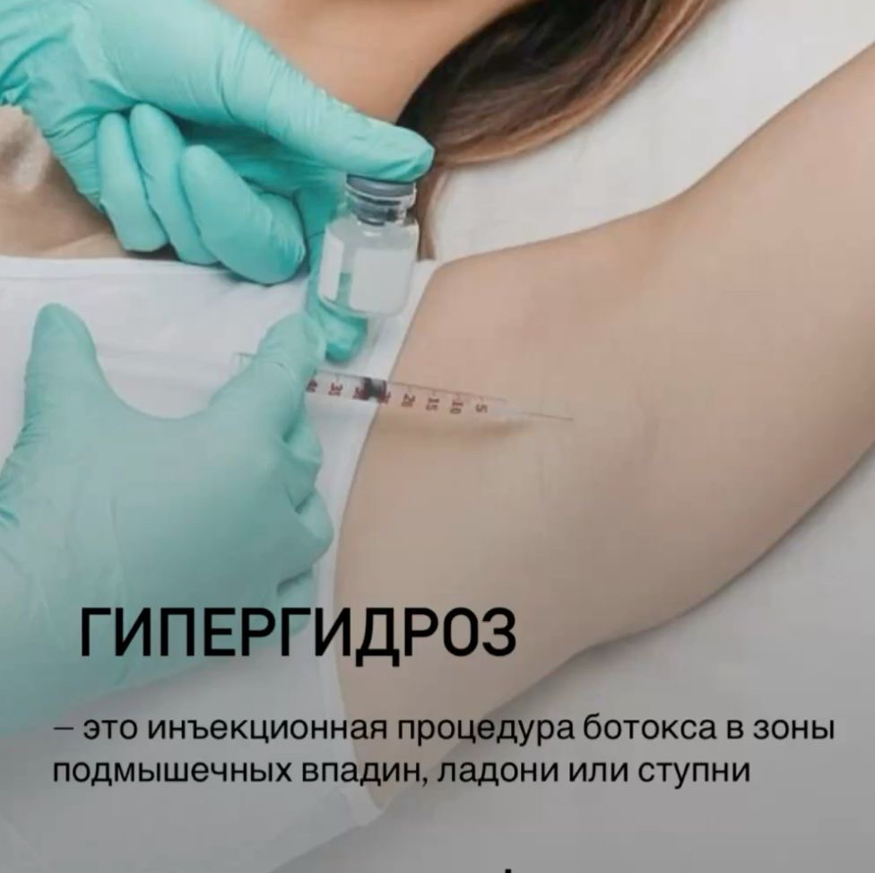 Гипергедроз