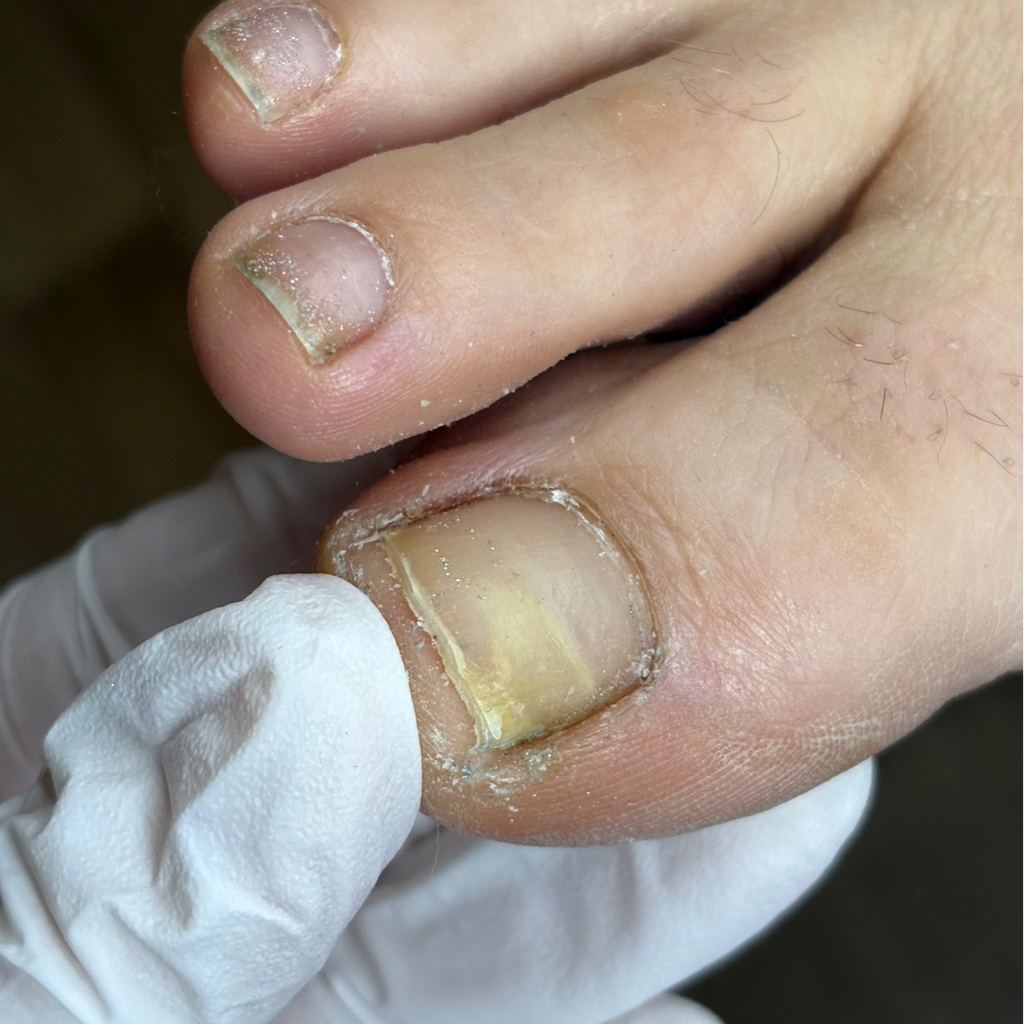 Обработка онихолизиса