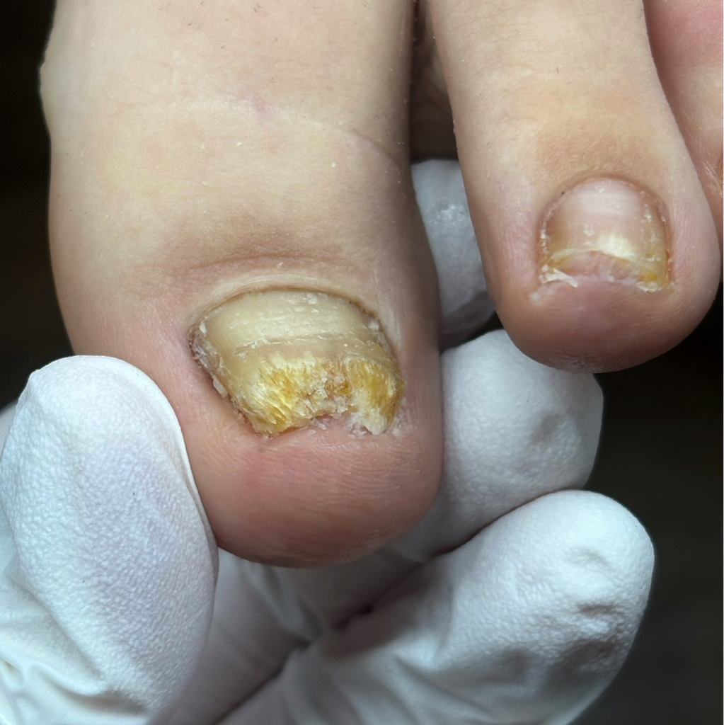 Обработка измененного по цвету и структуре ногтя