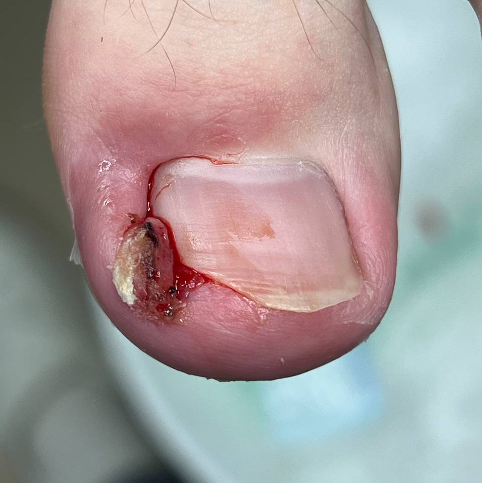 Обработка вросшего ногтя