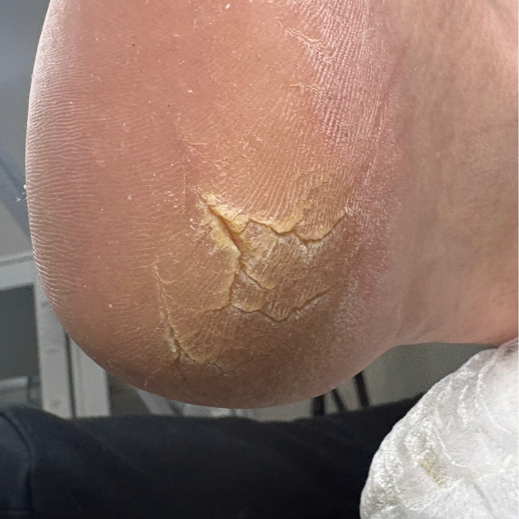 Аппаратная обработка мозоли, трещины