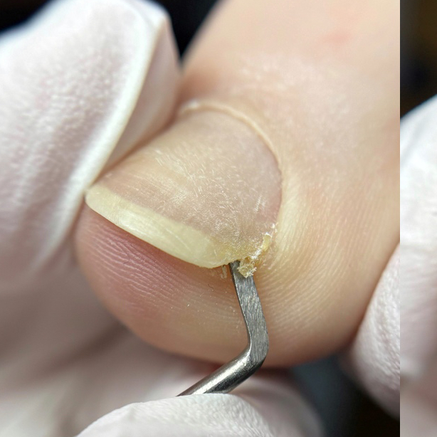 Повторная обработка вросшего угла