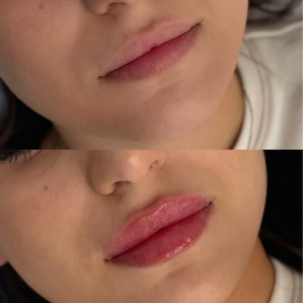 Увлажнение губы