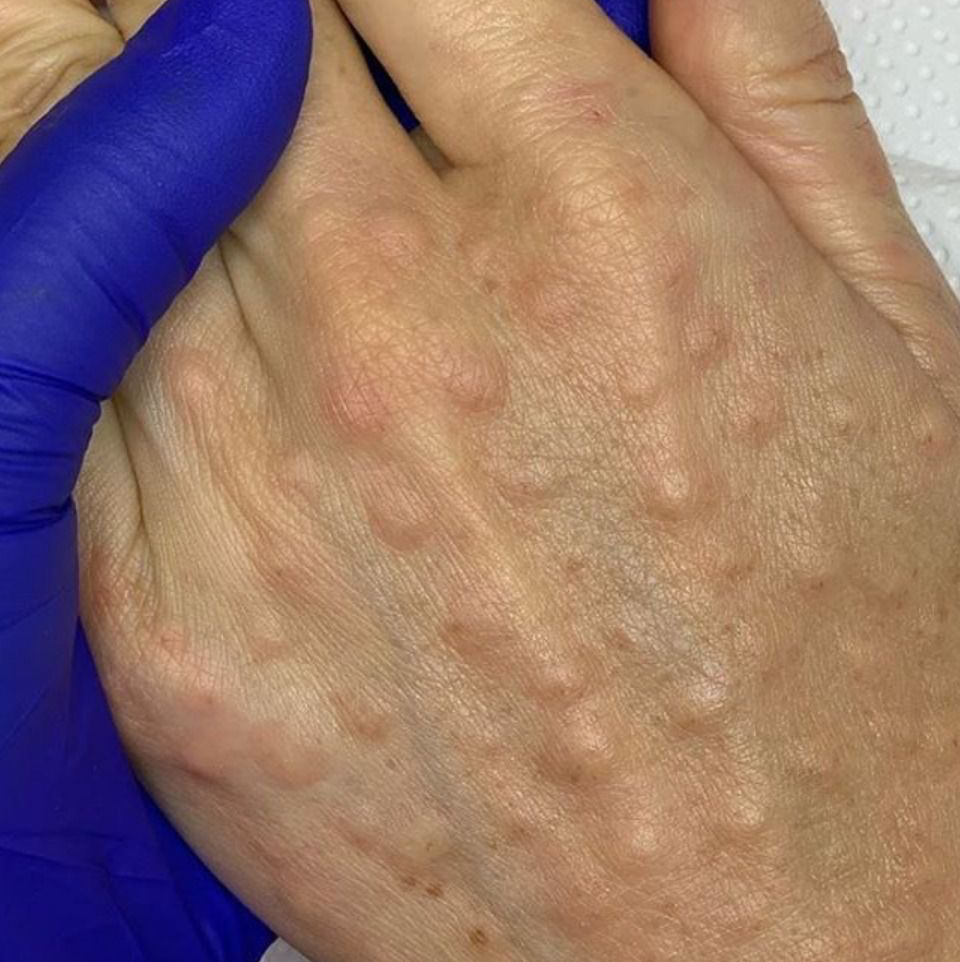 Мезотерапия руки