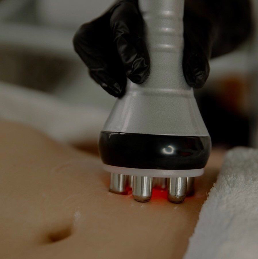 RF лифтинг- 40 минут