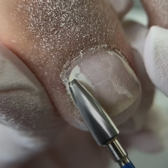 Снятие чужого покрытия ноги