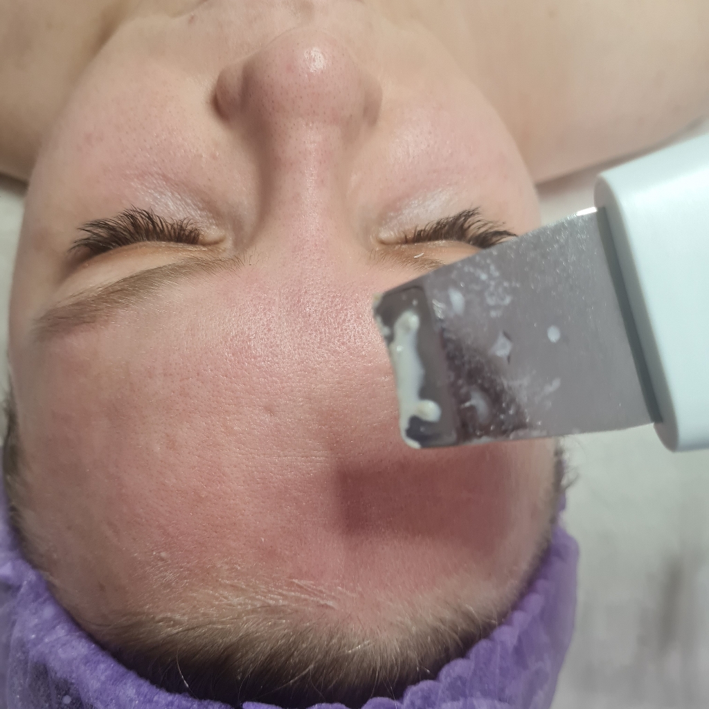 Чистка лица Уз