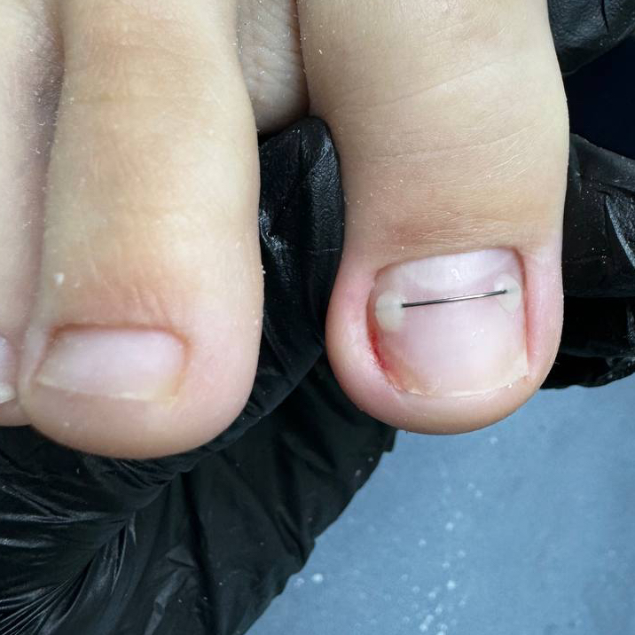 Титановая нить