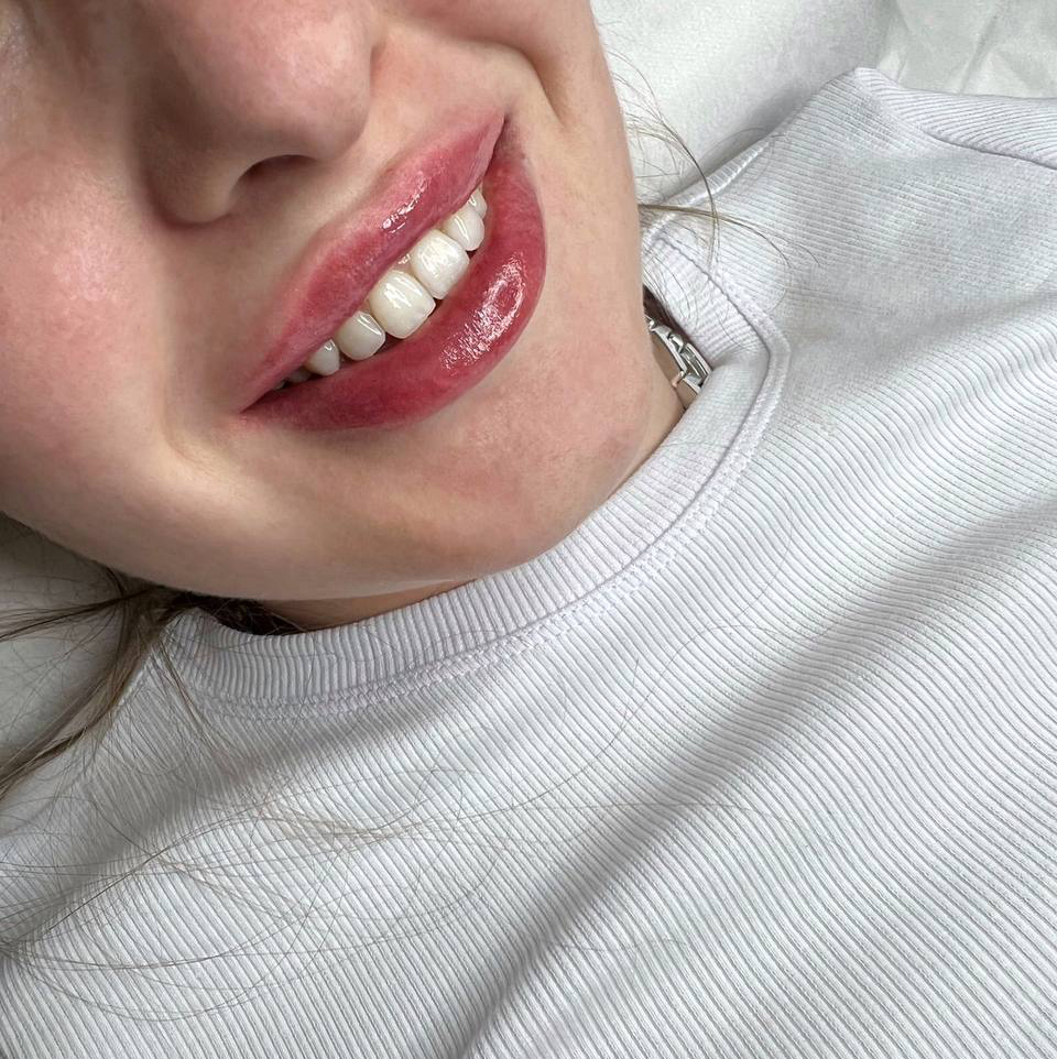 Увеличение губ (Контурная пластика губ)