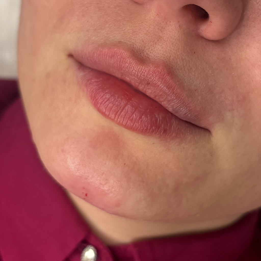 Увеличение губ 1 мл Philos