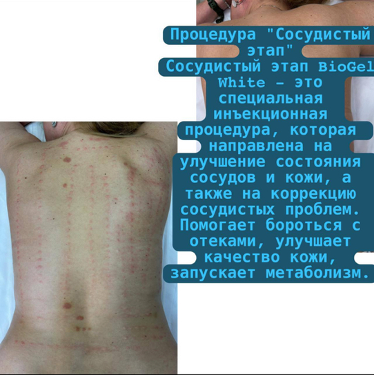 Сосудистый этап Биогель White 5.0 ml