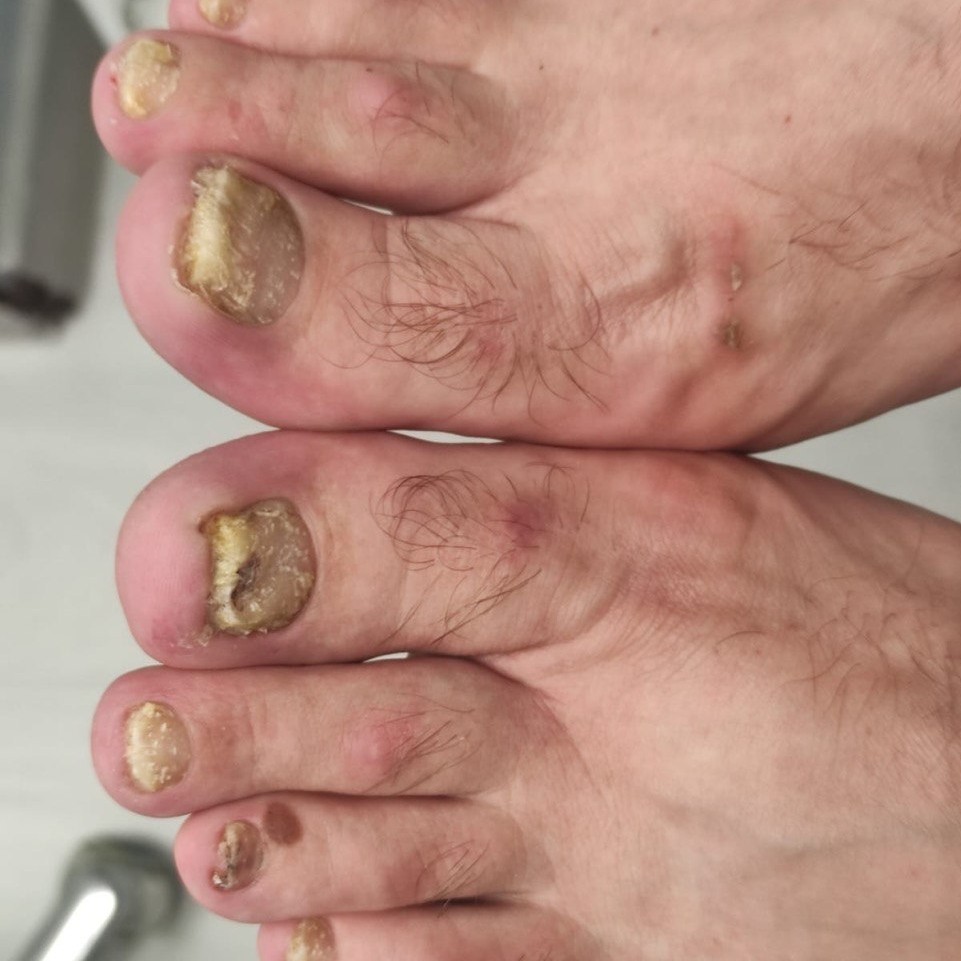 Комплексная обработка стоп и ногтей повышенной сложности