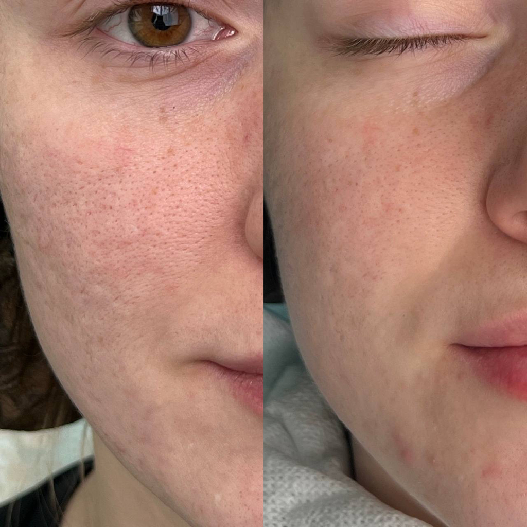 Плазма-Глоу (плазменная биоревитализация)