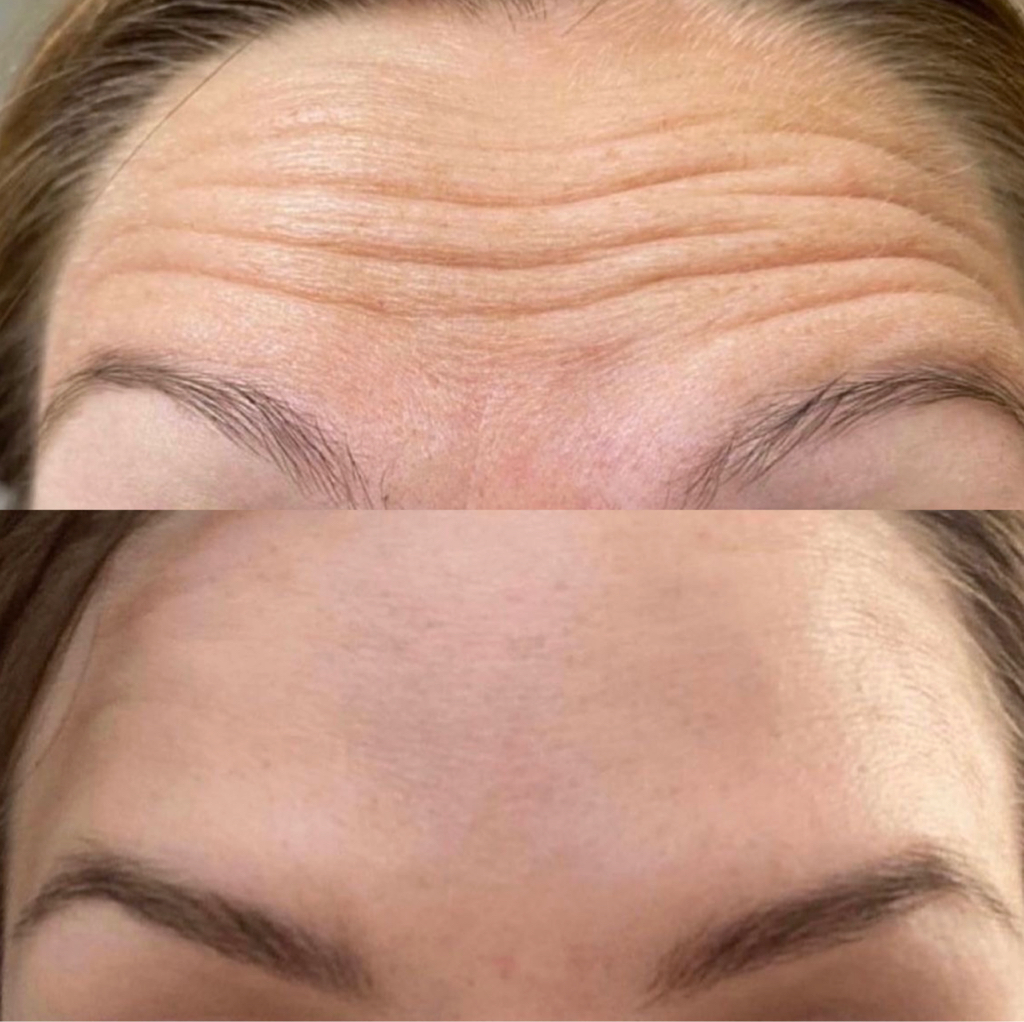Ботокс акция