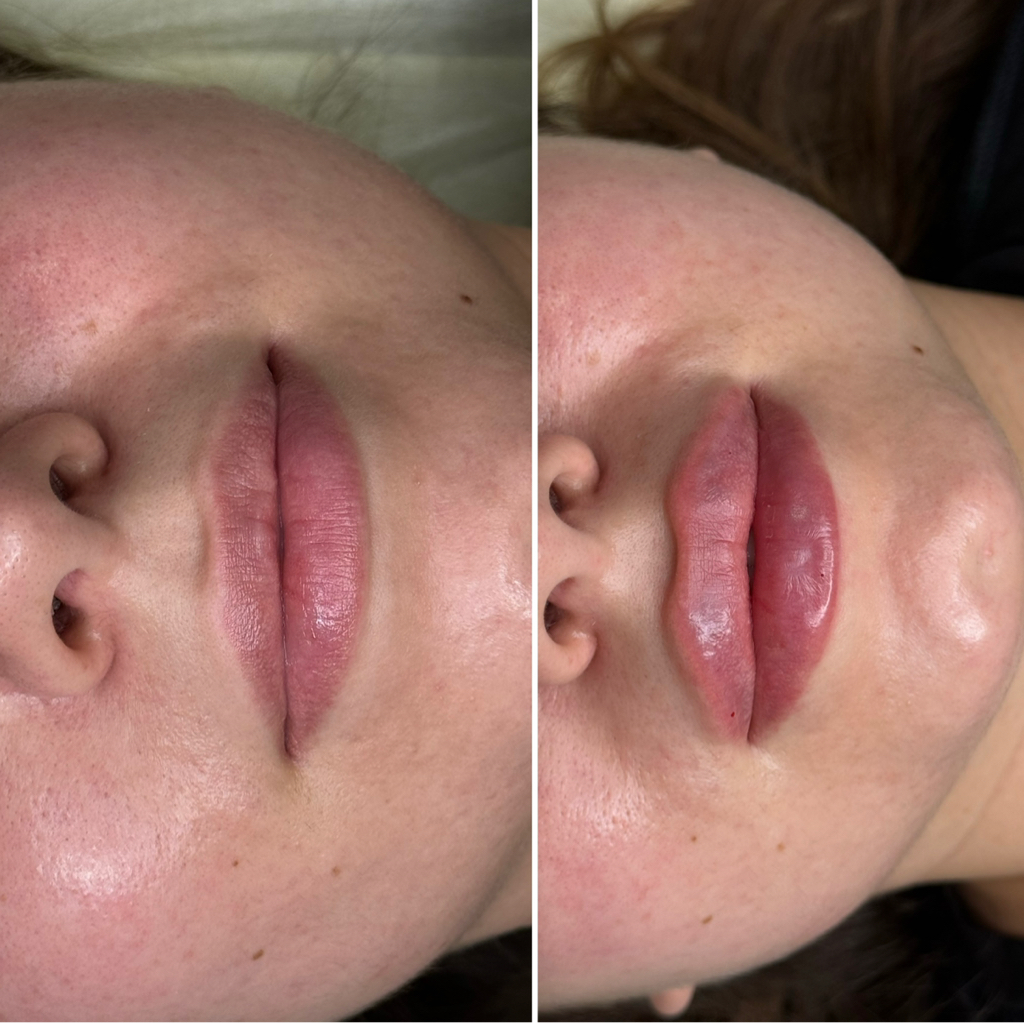 Neuramis deep (Корея)