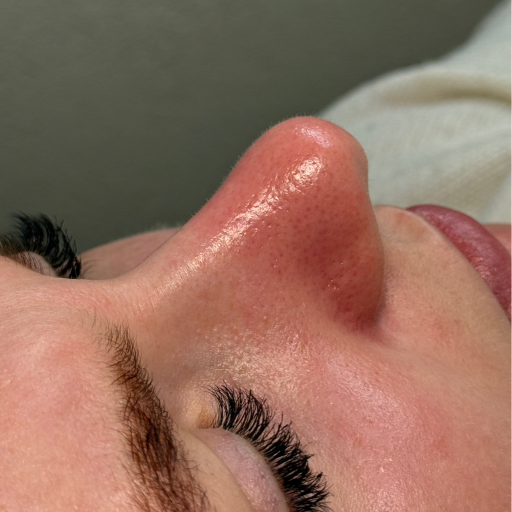 Комбинированная чистка лица + пилинг