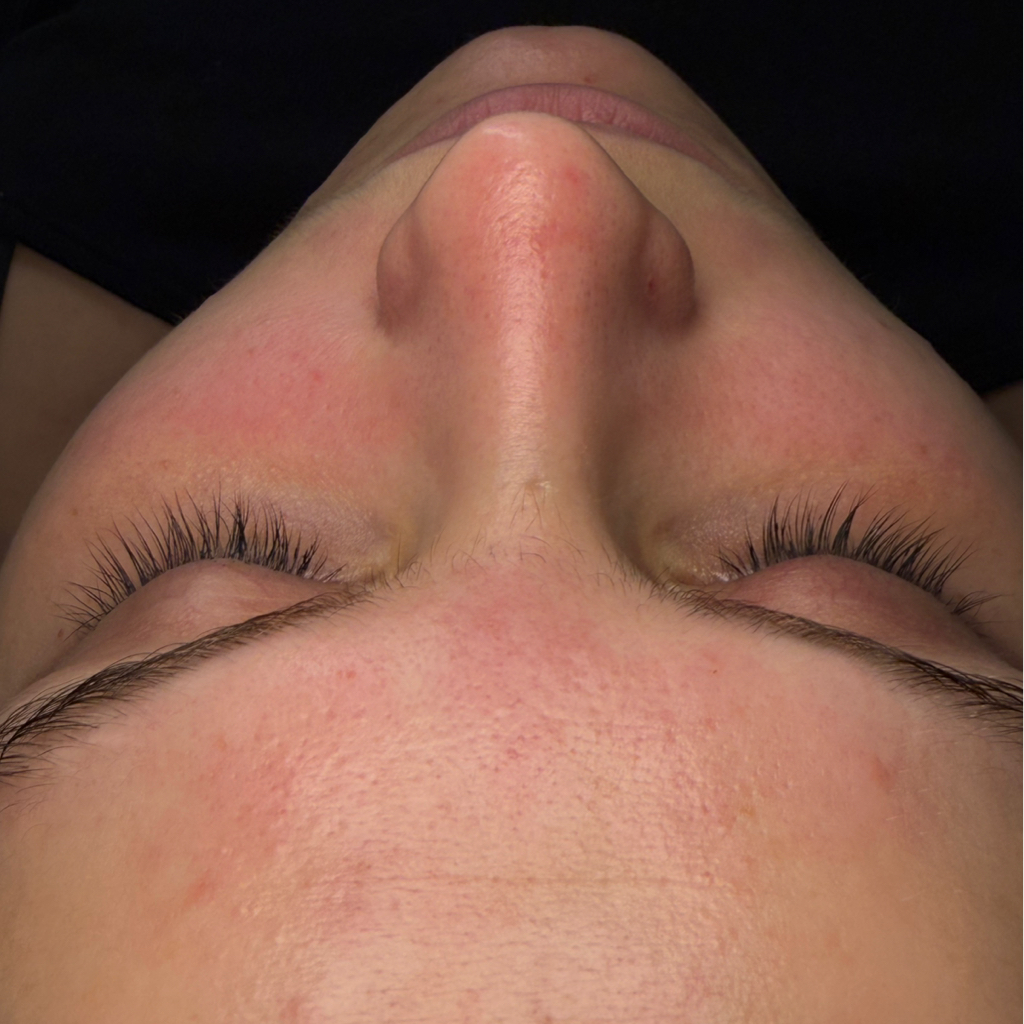 Комбинированная чистка лица + маска