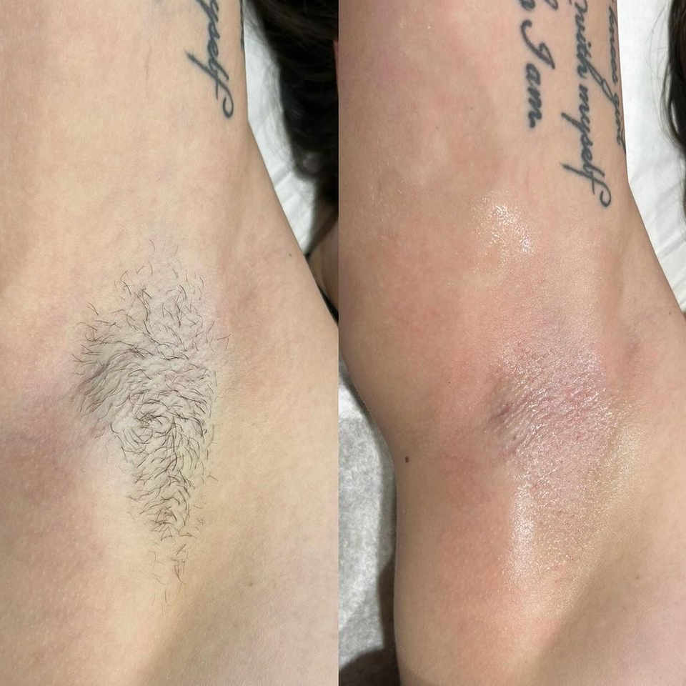 Восковая депиляция