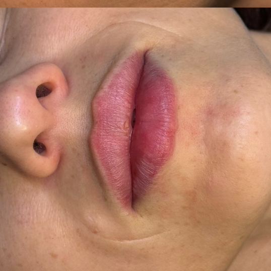 Биоревитализация/увлажнение/примерка губ