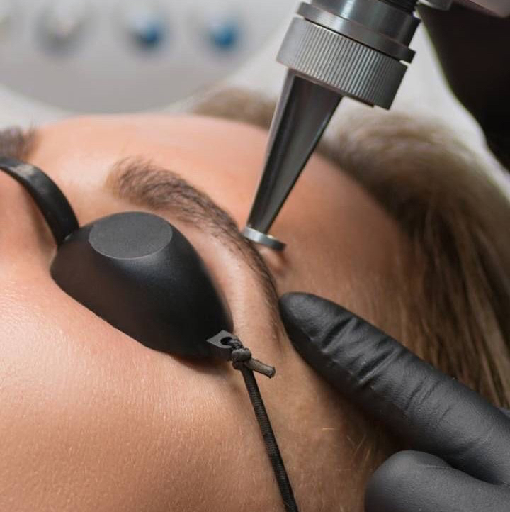 Удаление бровей лазером